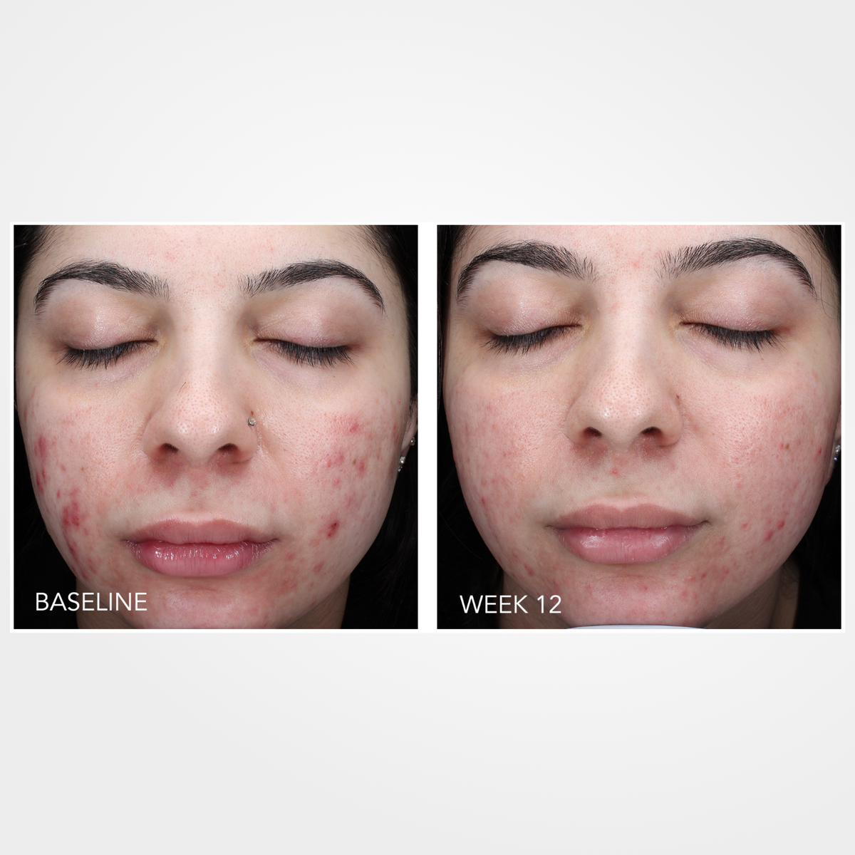 ZO Skin Health Acne Complex